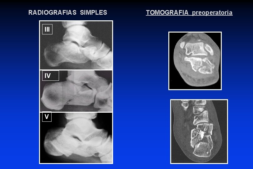 RADIOGRAFIAS SIMPLES III IV V TOMOGRAFIA preoperatoria RADIOGRAFIAS SIMPLES III IV V TOMOGRAFIA preoperatoria