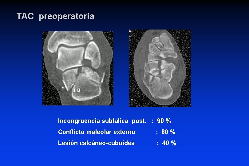 TAC preoperatoria II B Incongruencia subtalica post. : 90 % Conflicto maleolar externo : TAC preoperatoria II B Incongruencia subtalica post. : 90 % Conflicto maleolar externo :
