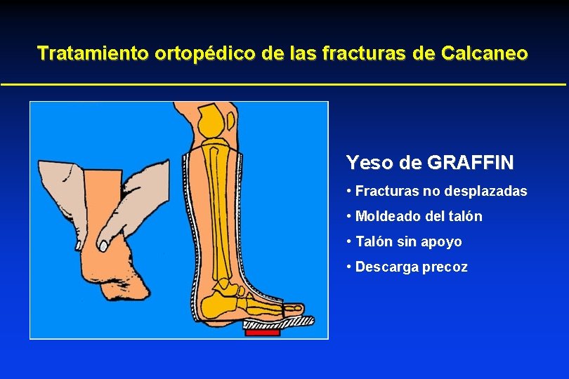 Tratamiento ortopédico de las fracturas de Calcaneo Yeso de GRAFFIN • Fracturas no desplazadas Tratamiento ortopédico de las fracturas de Calcaneo Yeso de GRAFFIN • Fracturas no desplazadas