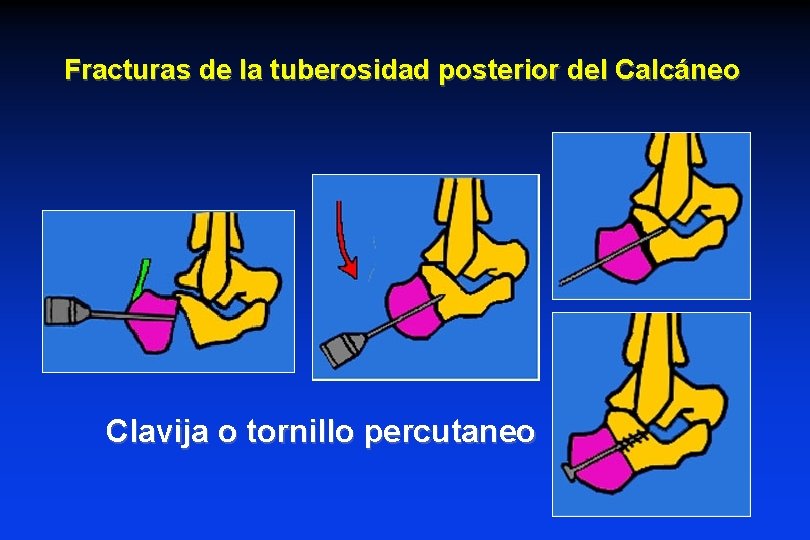 Fracturas de la tuberosidad posterior del Calcáneo Clavija o tornillo percutaneo Fracturas de la tuberosidad posterior del Calcáneo Clavija o tornillo percutaneo
