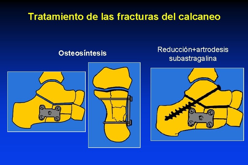Tratamiento de las fracturas del calcaneo Osteosíntesis Reducción+artrodesis subastragalina Tratamiento de las fracturas del calcaneo Osteosíntesis Reducción+artrodesis subastragalina