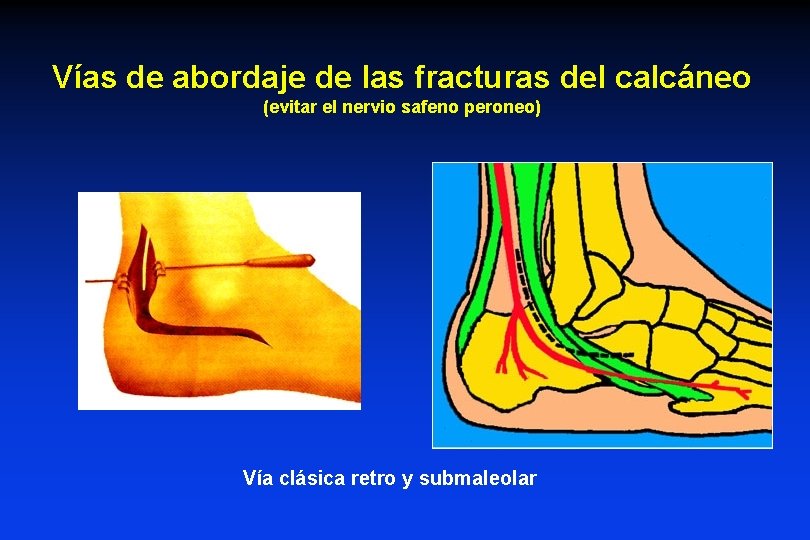 Vías de abordaje de las fracturas del calcáneo (evitar el nervio safeno peroneo) Vía Vías de abordaje de las fracturas del calcáneo (evitar el nervio safeno peroneo) Vía