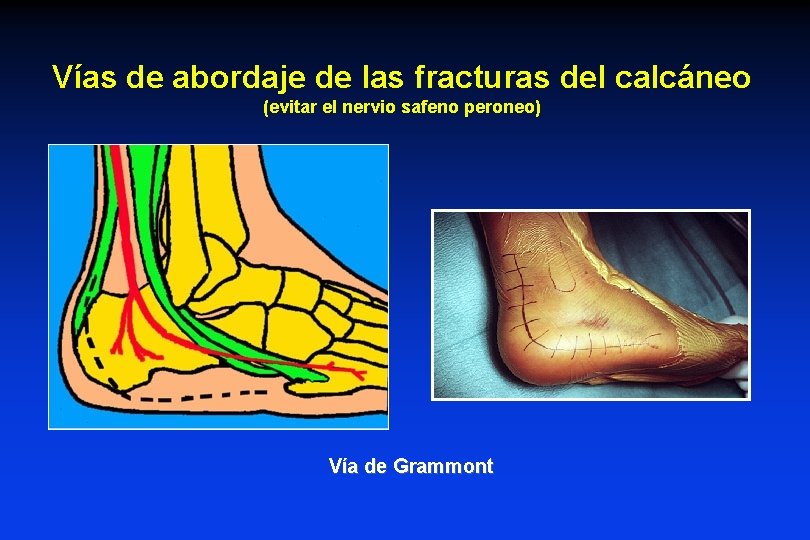 Vías de abordaje de las fracturas del calcáneo (evitar el nervio safeno peroneo) Vía Vías de abordaje de las fracturas del calcáneo (evitar el nervio safeno peroneo) Vía