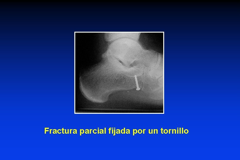 Fractura parcial fijada por un tornillo Fractura parcial fijada por un tornillo