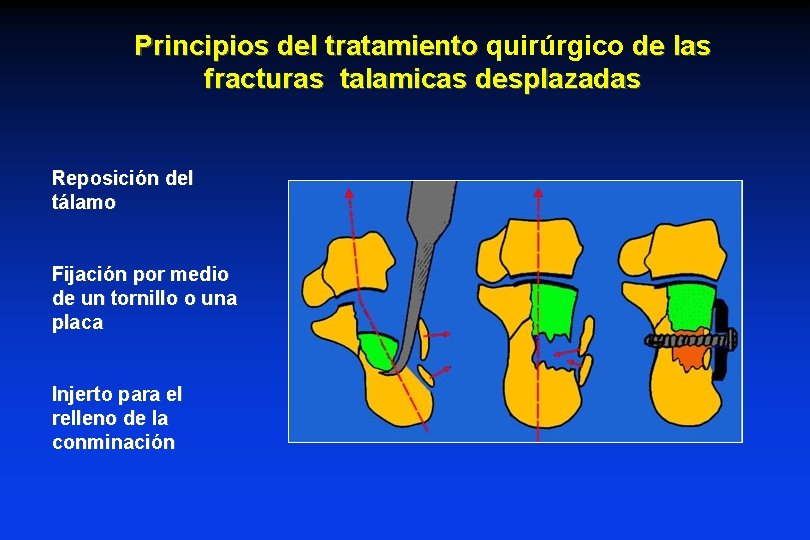 Principios del tratamiento quirúrgico de las fracturas talamicas desplazadas Reposición del tálamo Fijación por Principios del tratamiento quirúrgico de las fracturas talamicas desplazadas Reposición del tálamo Fijación por