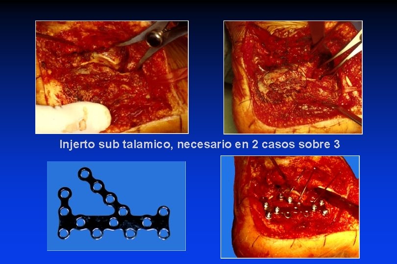 Injerto sub talamico, necesario en 2 casos sobre 3 Injerto sub talamico, necesario en 2 casos sobre 3