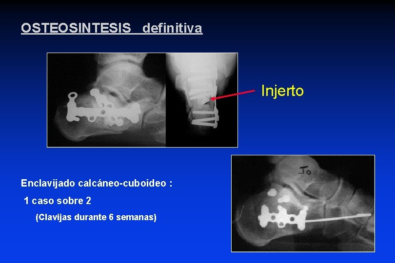 OSTEOSINTESIS definitiva Injerto Enclavijado calcáneo-cuboideo : 1 caso sobre 2 (Clavijas durante 6 semanas) OSTEOSINTESIS definitiva Injerto Enclavijado calcáneo-cuboideo : 1 caso sobre 2 (Clavijas durante 6 semanas)
