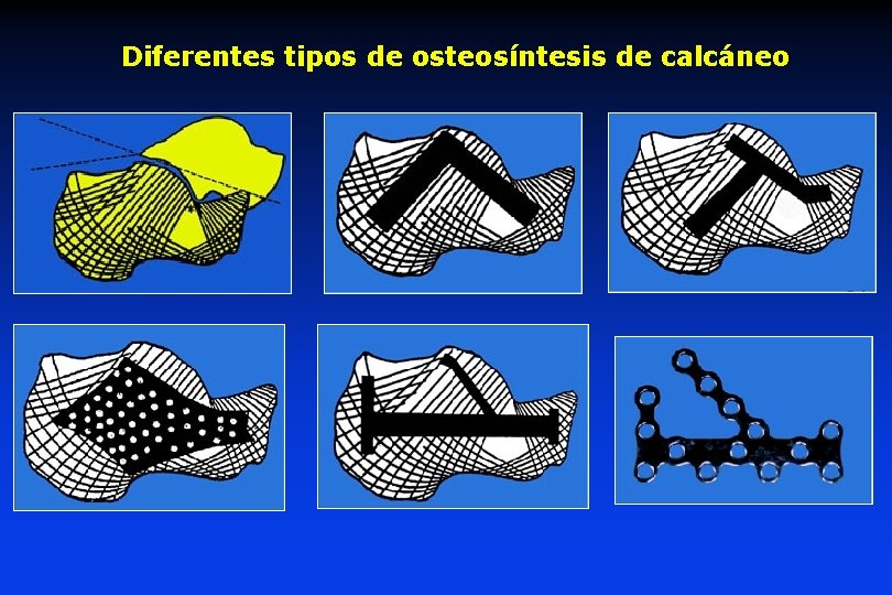 Diferentes tipos de osteosíntesis de calcáneo Diferentes tipos de osteosíntesis de calcáneo
