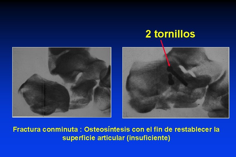 2 tornillos Fractura conminuta : Osteosíntesis con el fin de restablecer la superficie articular 2 tornillos Fractura conminuta : Osteosíntesis con el fin de restablecer la superficie articular