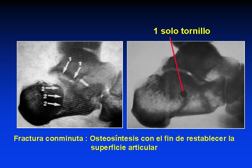 1 solo tornillo Fractura conminuta : Osteosíntesis con el fin de restablecer la superficie 1 solo tornillo Fractura conminuta : Osteosíntesis con el fin de restablecer la superficie