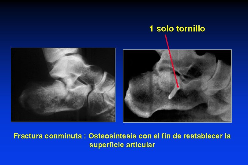 1 solo tornillo Fractura conminuta : Osteosíntesis con el fin de restablecer la superficie 1 solo tornillo Fractura conminuta : Osteosíntesis con el fin de restablecer la superficie