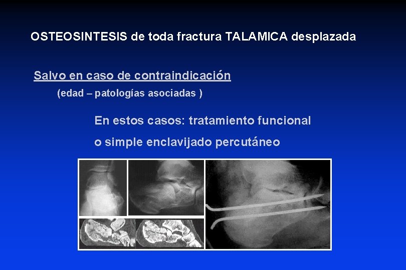 OSTEOSINTESIS de toda fractura TALAMICA desplazada Salvo en caso de contraindicación (edad – patologías OSTEOSINTESIS de toda fractura TALAMICA desplazada Salvo en caso de contraindicación (edad – patologías