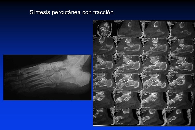 Síntesis percutánea con tracción. Síntesis percutánea con tracción.