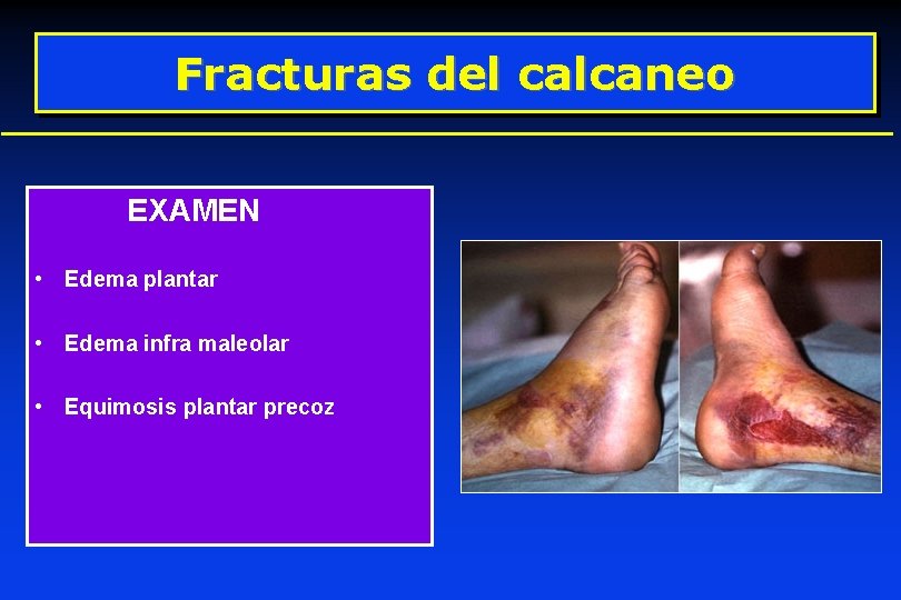 Fracturas del calcaneo EXAMEN • Edema plantar • Edema infra maleolar • Equimosis plantar Fracturas del calcaneo EXAMEN • Edema plantar • Edema infra maleolar • Equimosis plantar
