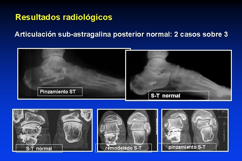 Resultados radiológicos Articulación sub-astragalina posterior normal: 2 casos sobre 3 Pinzamiento ST S-T normal Resultados radiológicos Articulación sub-astragalina posterior normal: 2 casos sobre 3 Pinzamiento ST S-T normal