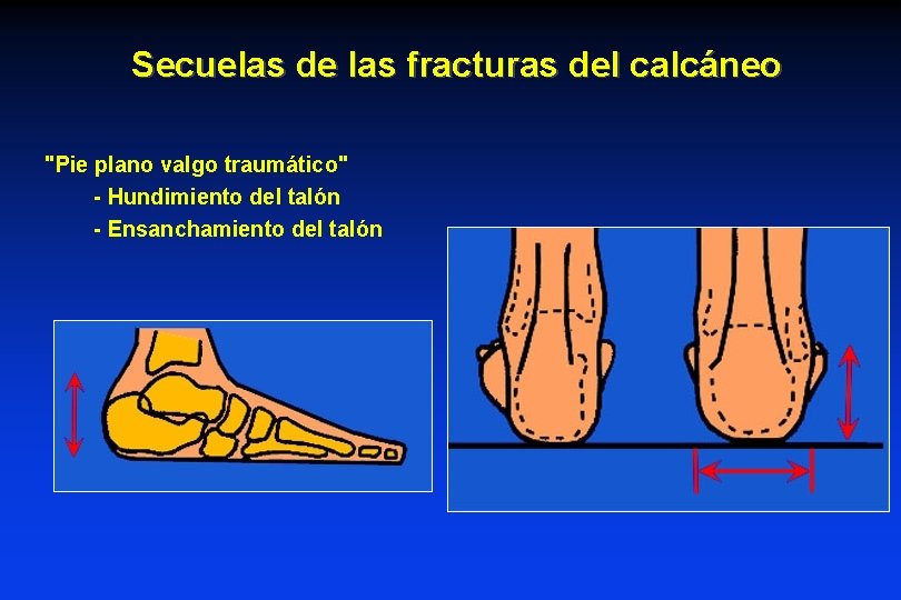 Secuelas de las fracturas del calcáneo "Pie plano valgo traumático" - Hundimiento del talón Secuelas de las fracturas del calcáneo "Pie plano valgo traumático" - Hundimiento del talón