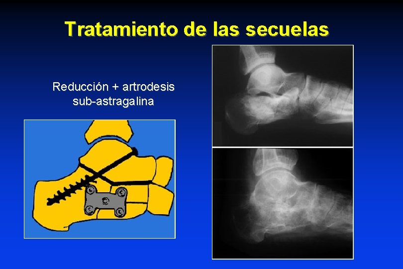 Tratamiento de las secuelas Reducción + artrodesis sub-astragalina Tratamiento de las secuelas Reducción + artrodesis sub-astragalina