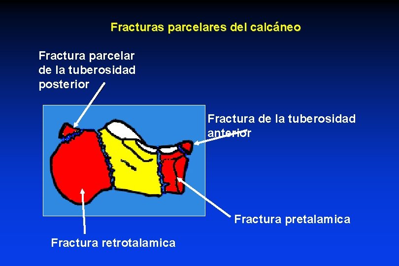 Fracturas parcelares del calcáneo Fractura parcelar de la tuberosidad posterior Fractura de la tuberosidad Fracturas parcelares del calcáneo Fractura parcelar de la tuberosidad posterior Fractura de la tuberosidad