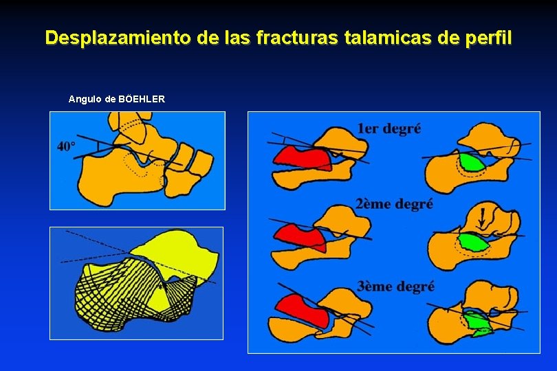 Desplazamiento de las fracturas talamicas de perfil Angulo de BÖEHLER Desplazamiento de las fracturas talamicas de perfil Angulo de BÖEHLER