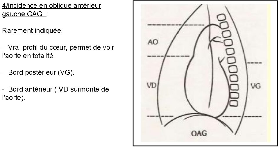 4/incidence en oblique antérieur gauche OAG : Rarement indiquée. - Vrai profil du cœur,