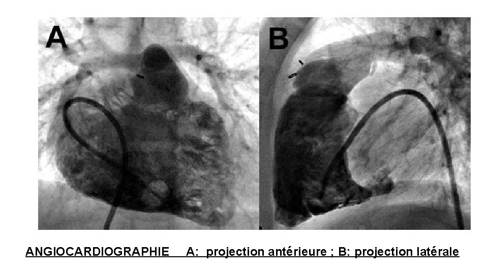 ANGIOCARDIOGRAPHIE A: projection antérieure ; B: projection latérale 
