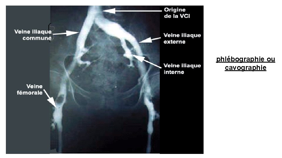 phlébographie ou cavographie 