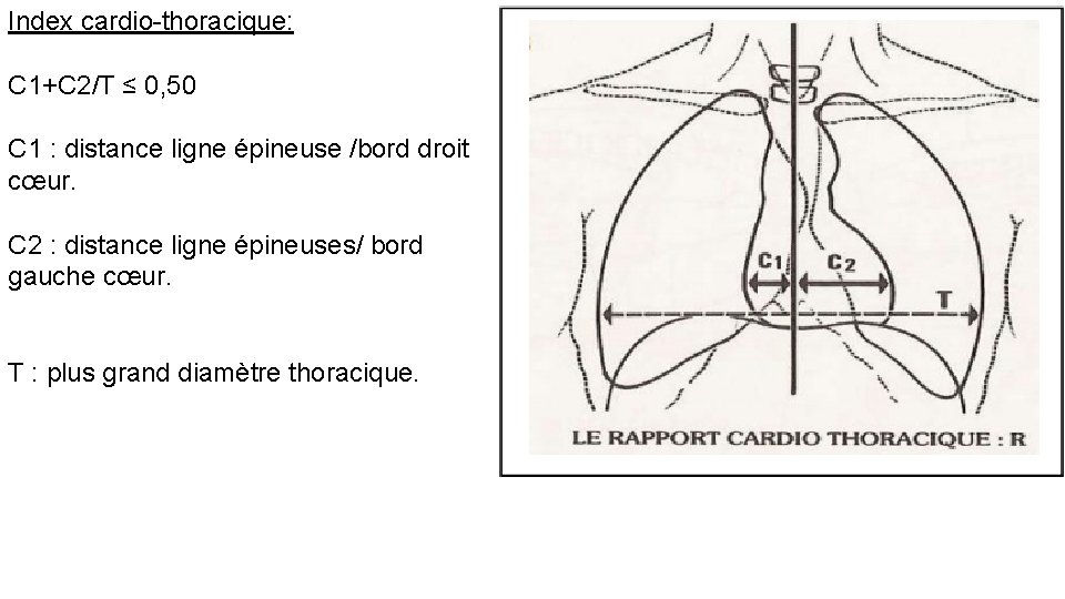 Index cardio-thoracique: C 1+C 2/T ≤ 0, 50 C 1 : distance ligne épineuse