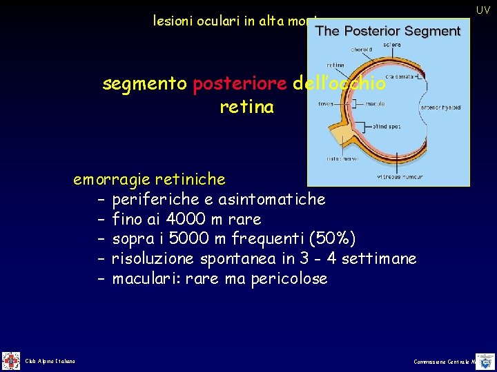 UV lesioni oculari in alta montagna segmento posteriore dell’occhio retina emorragie retiniche – periferiche UV lesioni oculari in alta montagna segmento posteriore dell’occhio retina emorragie retiniche – periferiche