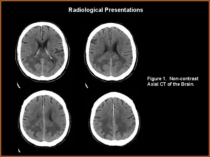 Radiological Presentations Figure 1. Non-contrast Axial CT of the Brain. 