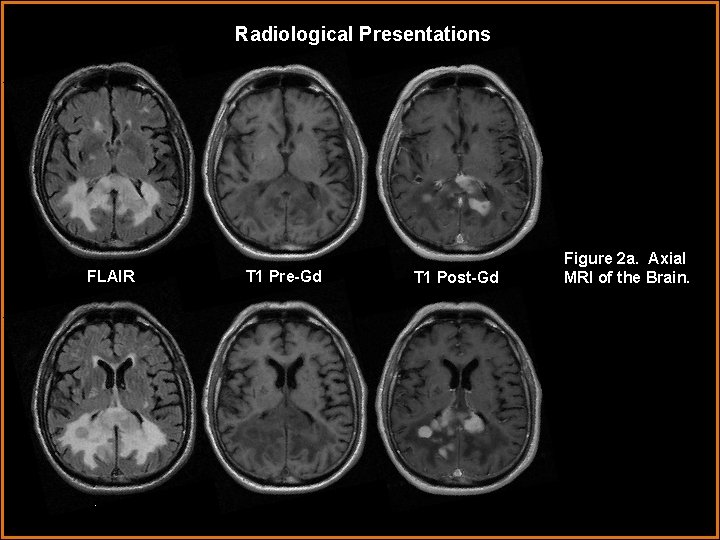 Radiological Presentations FLAIR T 1 Pre-Gd T 1 Post-Gd Figure 2 a. Axial MRI