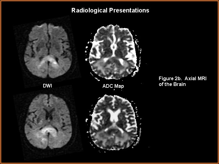 Radiological Presentations DWI ADC Map Figure 2 b. Axial MRI of the Brain 