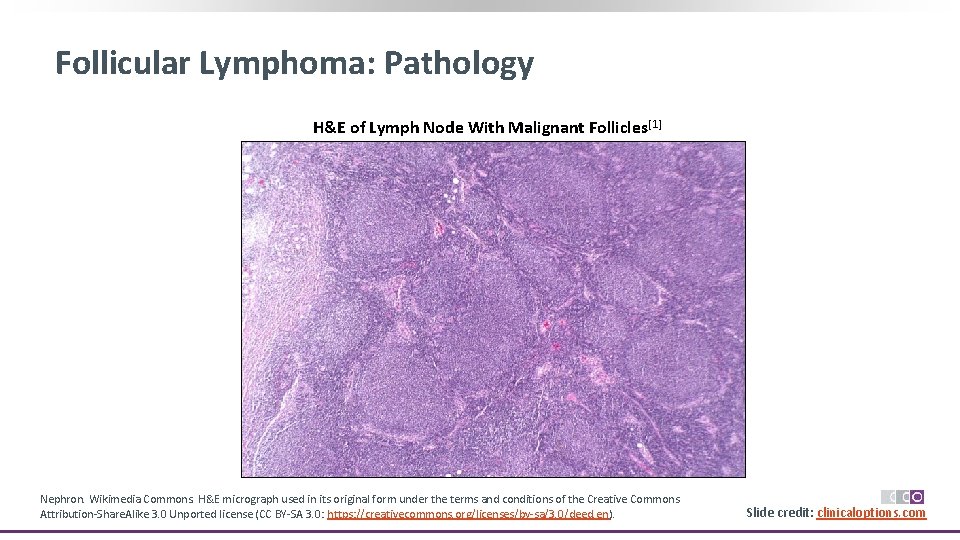 Follicular Lymphoma: Pathology H&E of Lymph Node With Malignant Follicles[1] Nephron. Wikimedia Commons. H&E