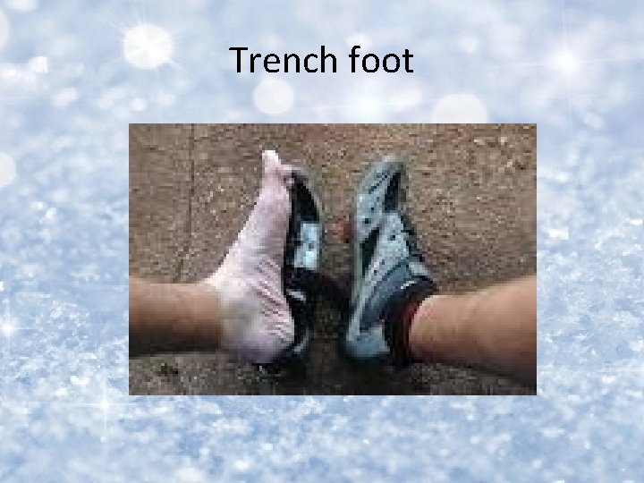 Trench foot 