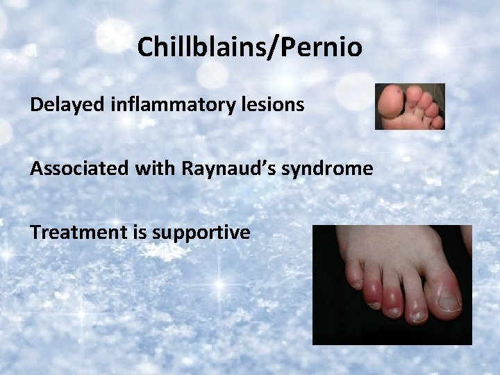 Chillblains/Pernio Delayed inflammatory lesions Associated with Raynaud’s syndrome Treatment is supportive 