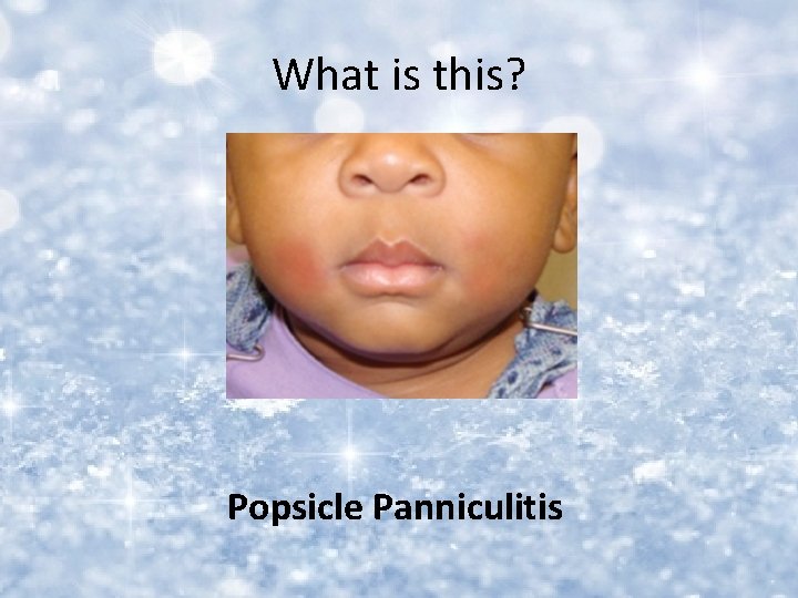 What is this? Popsicle Panniculitis 