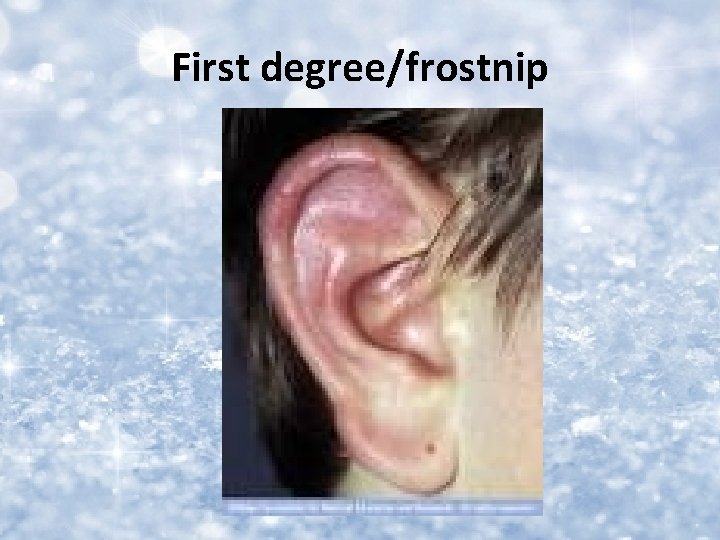 First degree/frostnip 