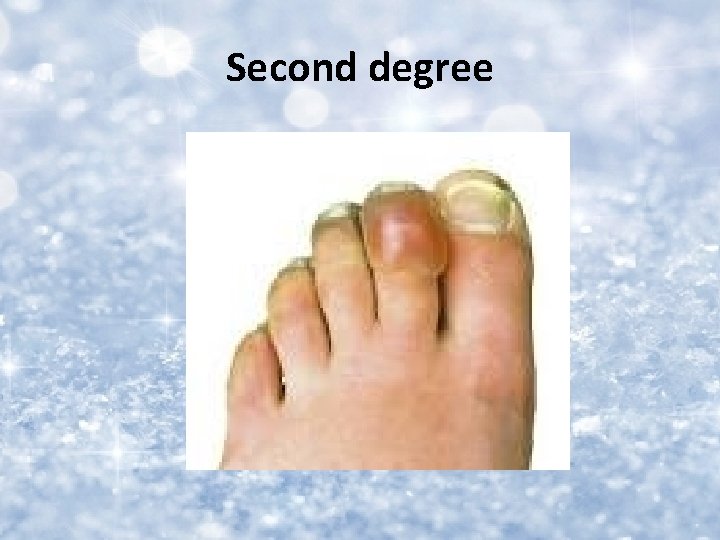 Second degree 