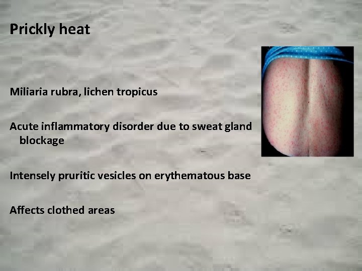 Prickly heat Miliaria rubra, lichen tropicus Acute inflammatory disorder due to sweat gland blockage