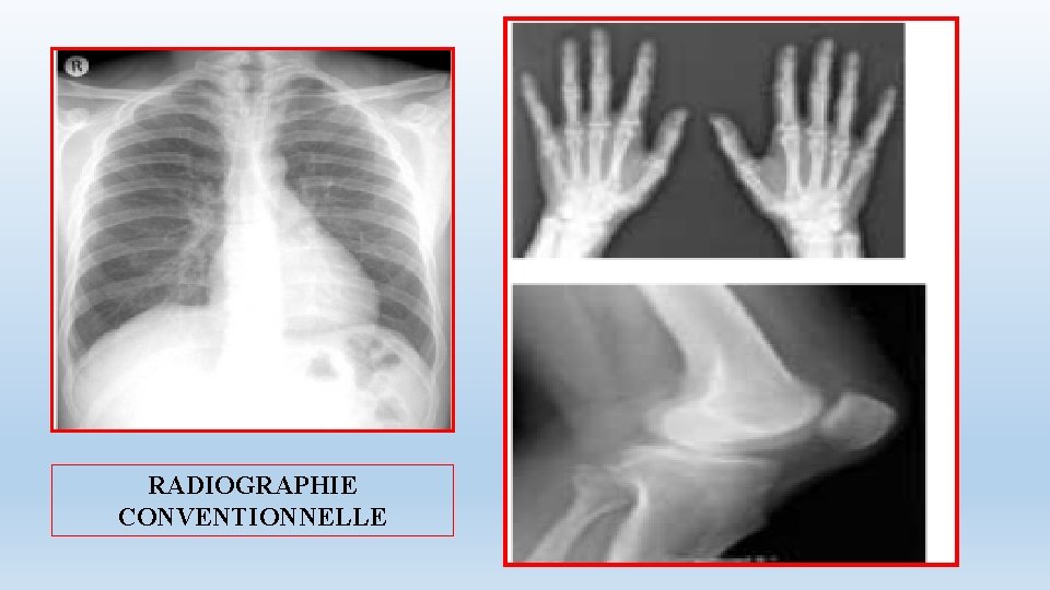 RADIOGRAPHIE CONVENTIONNELLE 