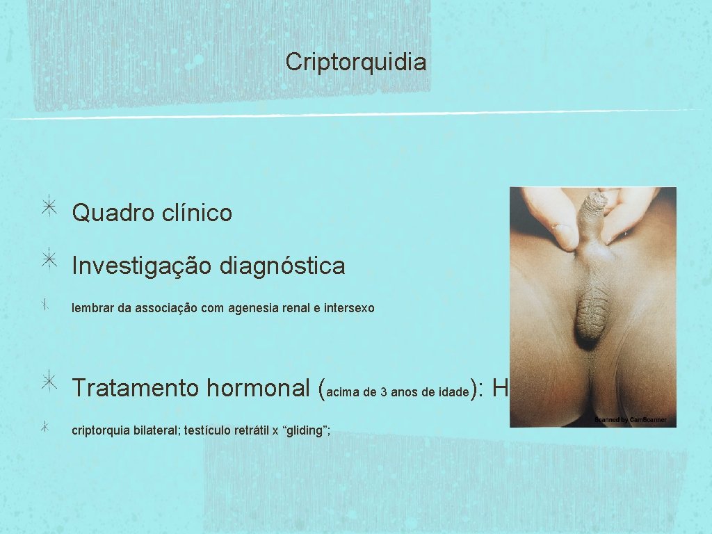 Criptorquidia Quadro clínico Investigação diagnóstica lembrar da associação com agenesia renal e intersexo Tratamento