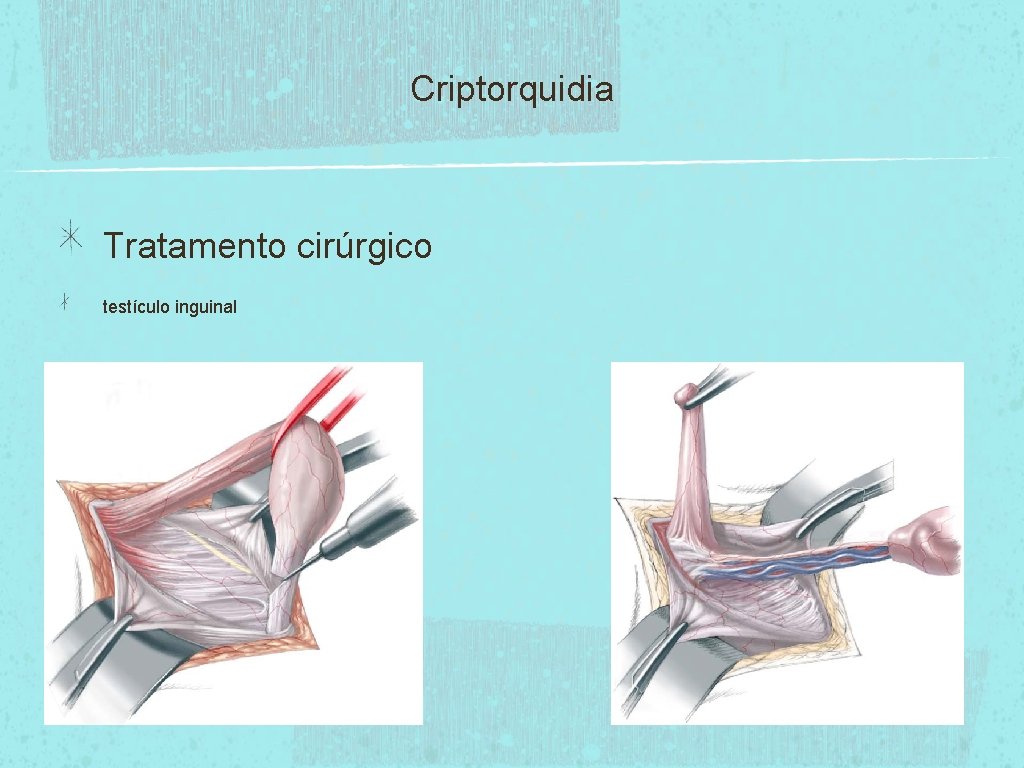 Criptorquidia Tratamento cirúrgico testículo inguinal 