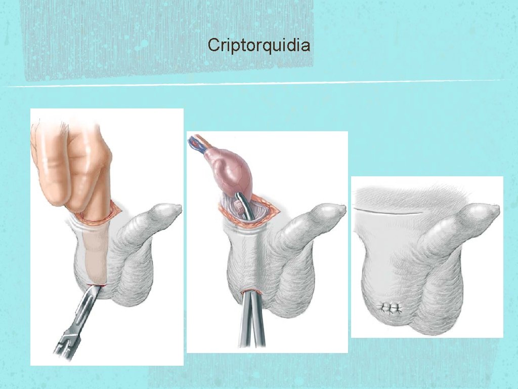 Criptorquidia 