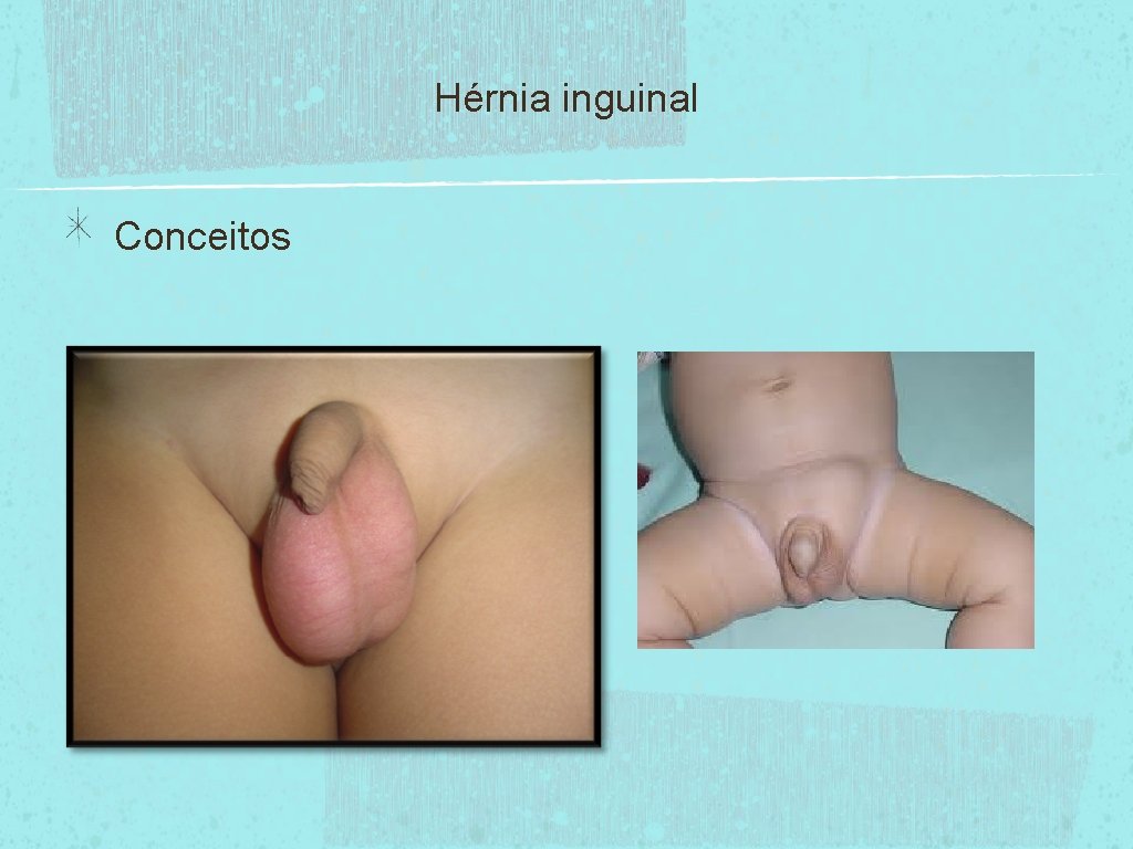 Hérnia inguinal Conceitos 