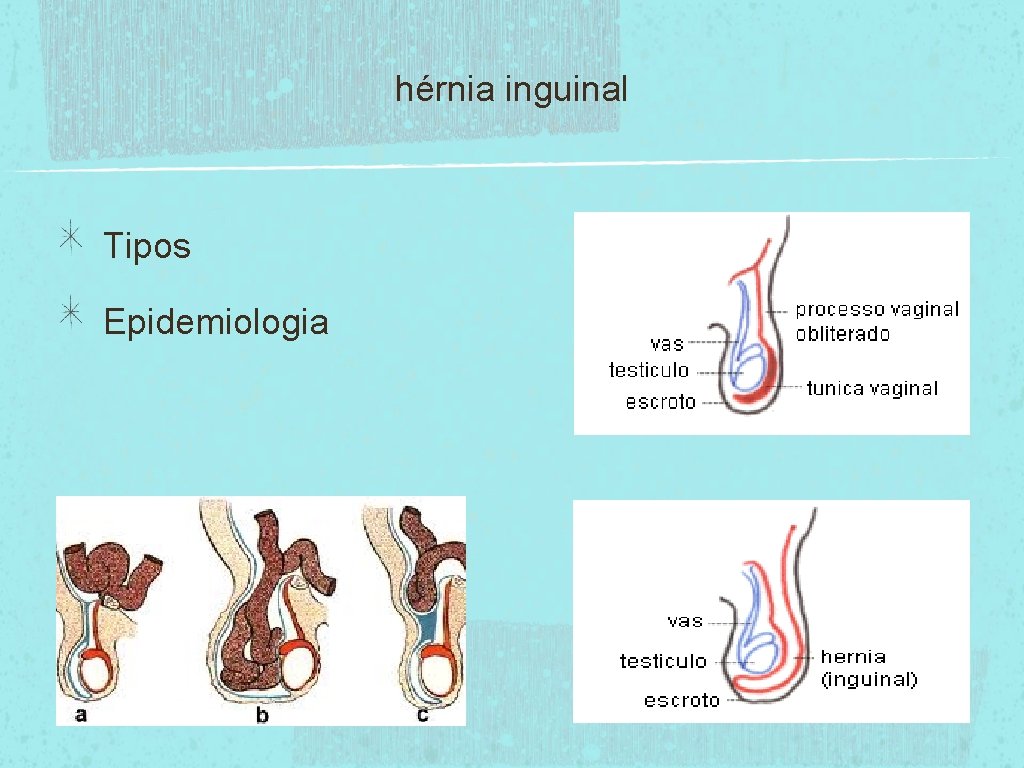 hérnia inguinal Tipos Epidemiologia 