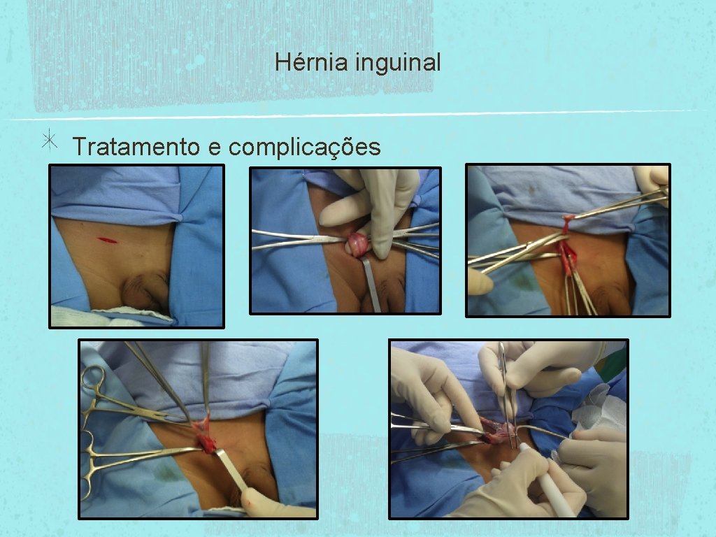 Hérnia inguinal Tratamento e complicações 