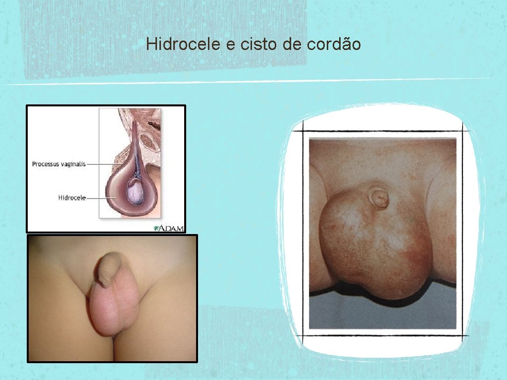 Hidrocele e cisto de cordão 