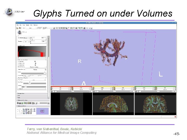 Glyphs Turned on under Volumes Pujol S, Gollub R Terry, von Siebenthal, Bouix, Kubicki Glyphs Turned on under Volumes Pujol S, Gollub R Terry, von Siebenthal, Bouix, Kubicki