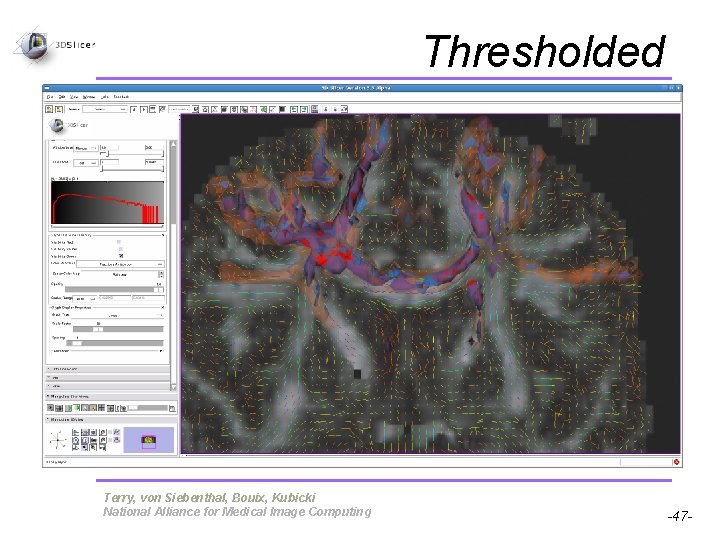 Thresholded Pujol S, Gollub R Terry, von Siebenthal, Bouix, Kubicki National Alliance for Medical Thresholded Pujol S, Gollub R Terry, von Siebenthal, Bouix, Kubicki National Alliance for Medical