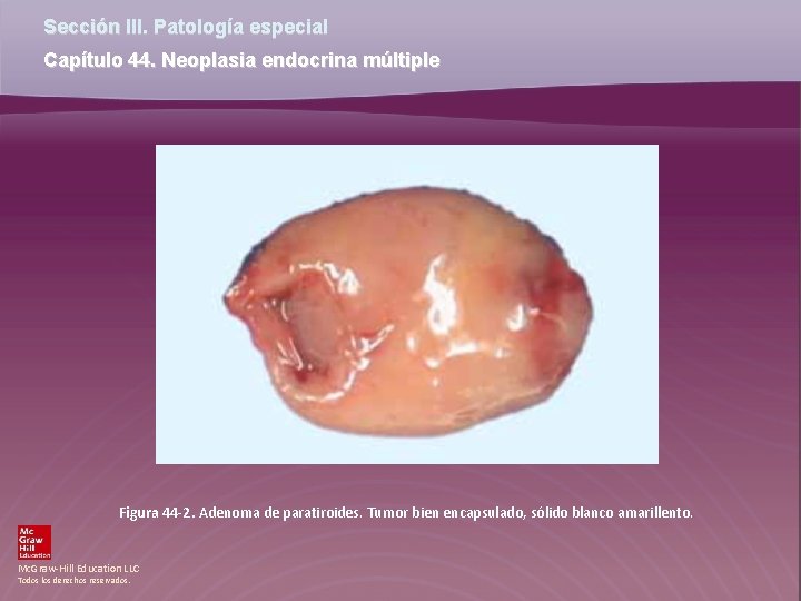 Sección III. Patología especial Capítulo 44. Neoplasia endocrina múltiple Figura 44 -2. Adenoma de