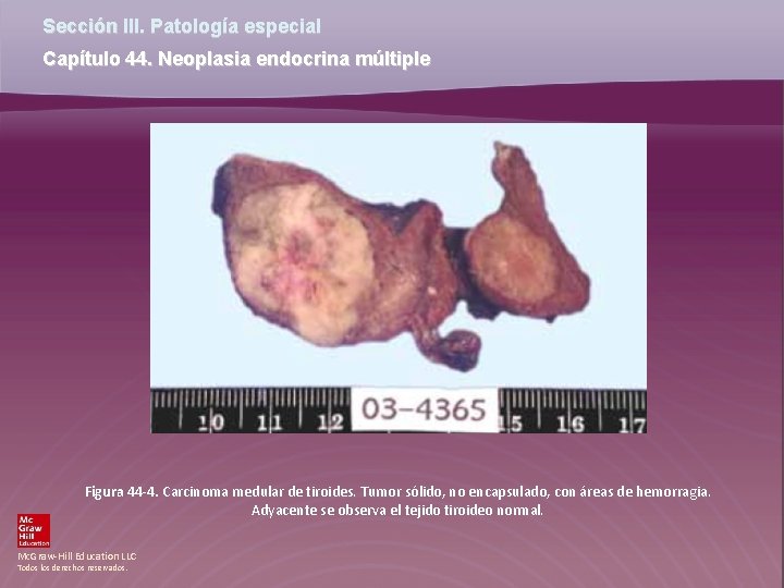 Sección III. Patología especial Capítulo 44. Neoplasia endocrina múltiple Figura 44 -4. Carcinoma medular